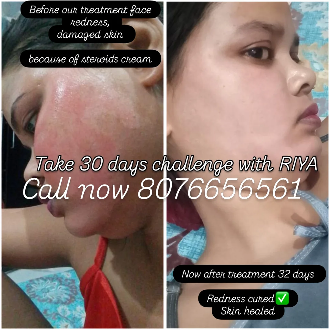 Steroid damage & redness — before and after