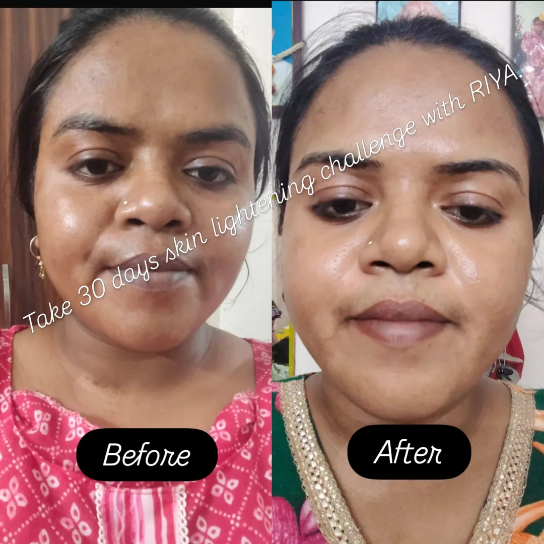Even skin tone care — before and after